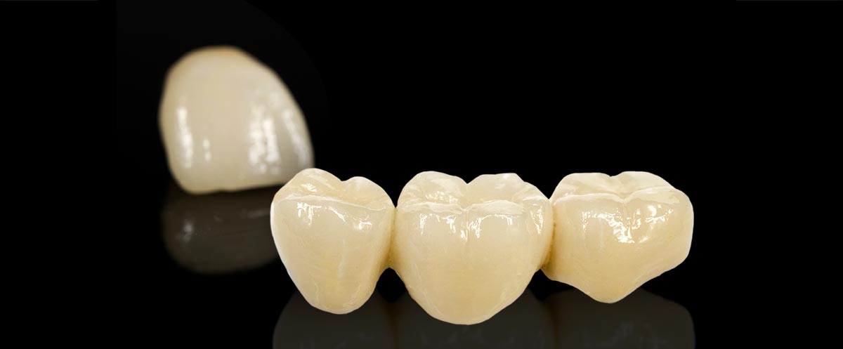Why Patients Should Choose All Ceramic Restorations Instead Of Pfm Porcelain Fused To Metal Solaris Dental Design